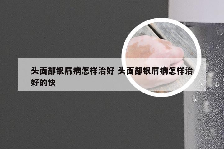 头面部银屑病怎样治好 头面部银屑病怎样治好的快