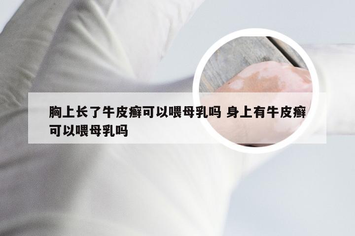 胸上长了牛皮癣可以喂母乳吗 身上有牛皮癣可以喂母乳吗