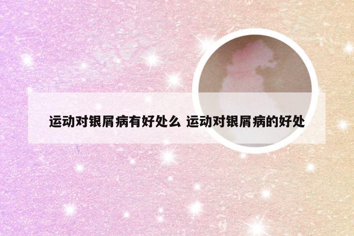 运动对银屑病有好处么 运动对银屑病的好处