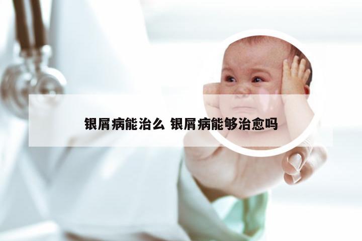 银屑病能治么 银屑病能够治愈吗