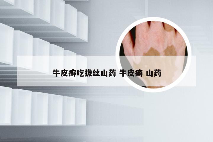 牛皮癣吃拔丝山药 牛皮癣 山药