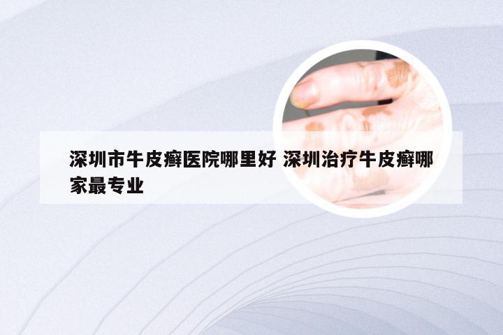 深圳市牛皮癣医院哪里好 深圳治疗牛皮癣哪家最专业