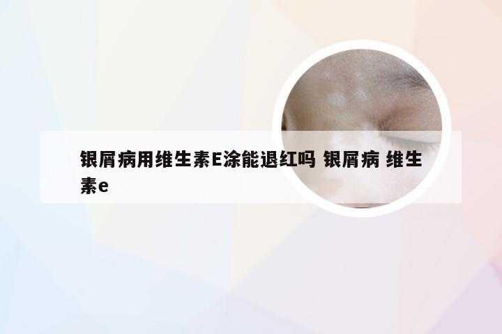 银屑病用维生素E涂能退红吗 银屑病 维生素e