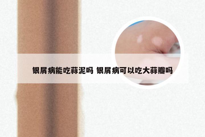 银屑病能吃蒜泥吗 银屑病可以吃大蒜瓣吗