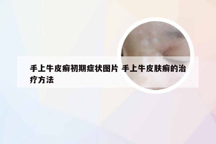 手上牛皮癣初期症状图片 手上牛皮肤癣的治疗方法
