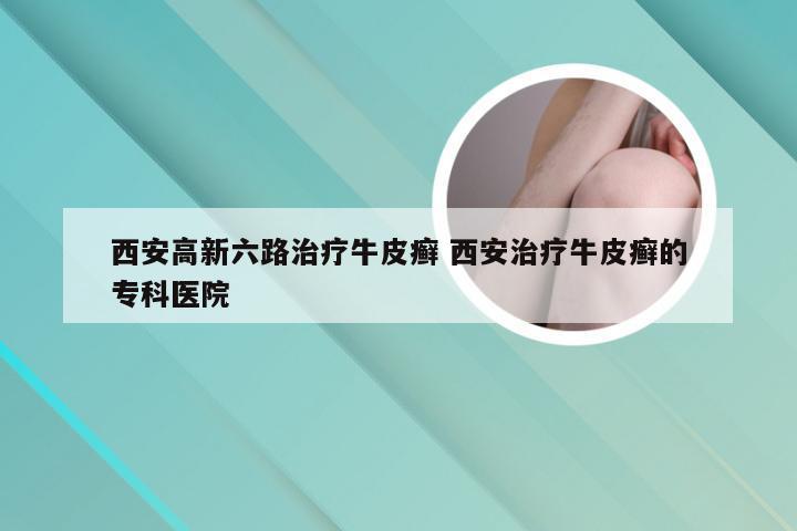 西安高新六路治疗牛皮癣 西安治疗牛皮癣的专科医院