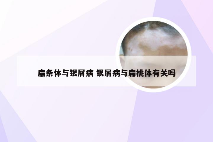 扁条体与银屑病 银屑病与扁桃体有关吗