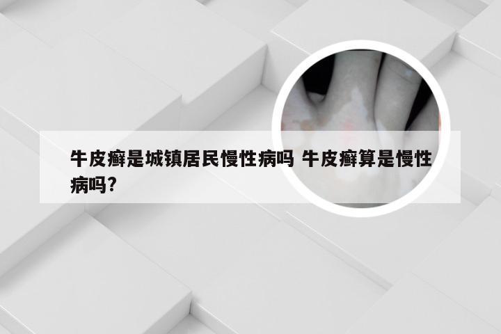 牛皮癣是城镇居民慢性病吗 牛皮癣算是慢性病吗?