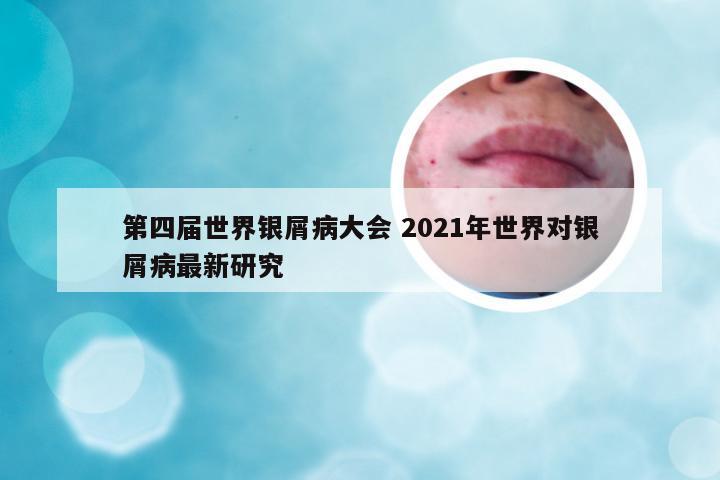 第四届世界银屑病大会 2021年世界对银屑病最新研究