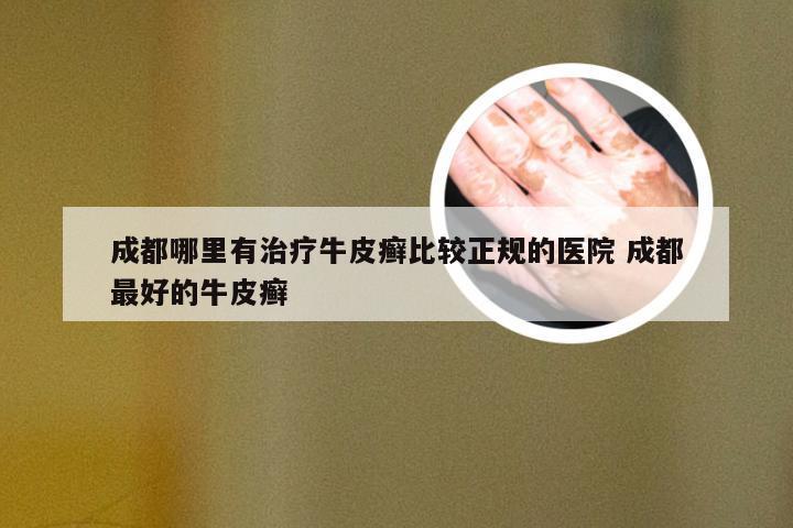成都哪里有治疗牛皮癣比较正规的医院 成都最好的牛皮癣