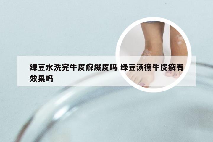 绿豆水洗完牛皮癣爆皮吗 绿豆汤擦牛皮癣有效果吗