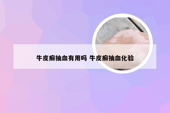 牛皮癣抽血有用吗 牛皮癣抽血化验