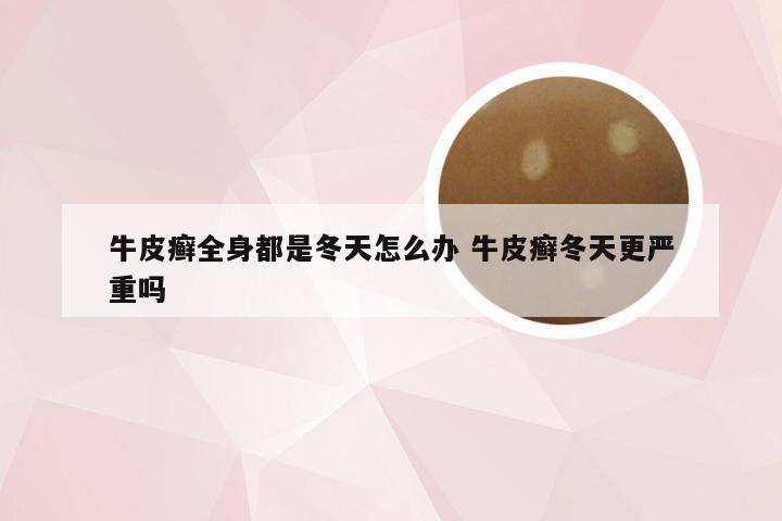 牛皮癣全身都是冬天怎么办 牛皮癣冬天更严重吗