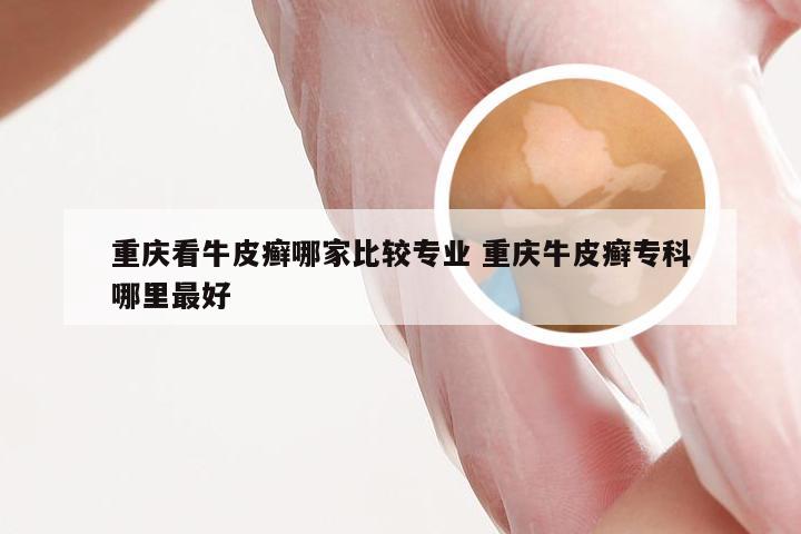 重庆看牛皮癣哪家比较专业 重庆牛皮癣专科哪里最好