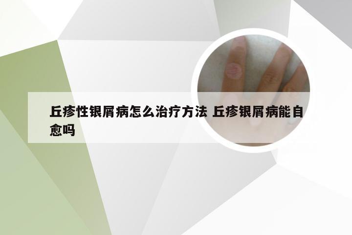 丘疹性银屑病怎么治疗方法 丘疹银屑病能自愈吗