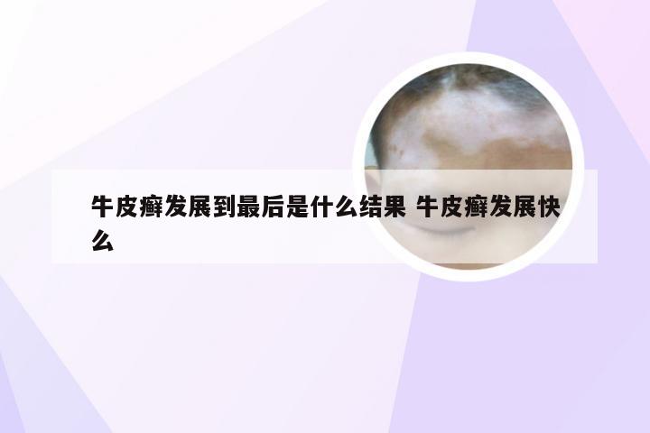 牛皮癣发展到最后是什么结果 牛皮癣发展快么