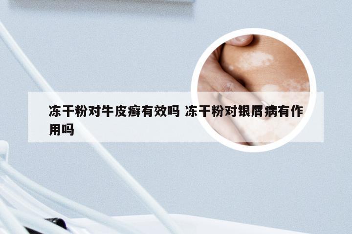 冻干粉对牛皮癣有效吗 冻干粉对银屑病有作用吗