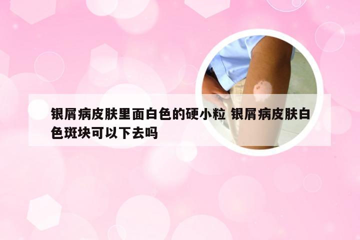 银屑病皮肤里面白色的硬小粒 银屑病皮肤白色斑块可以下去吗