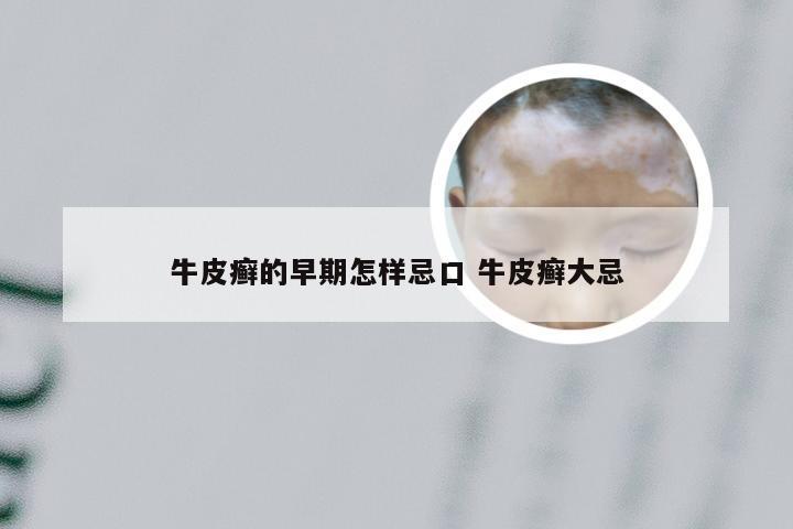 牛皮癣的早期怎样忌口 牛皮癣大忌