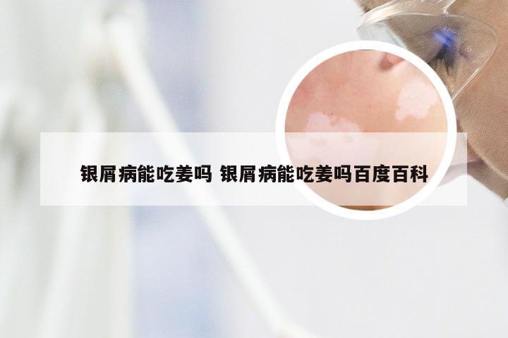银屑病能吃姜吗 银屑病能吃姜吗百度百科