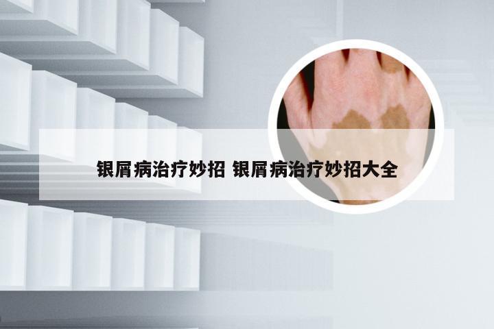 银屑病治疗妙招 银屑病治疗妙招大全