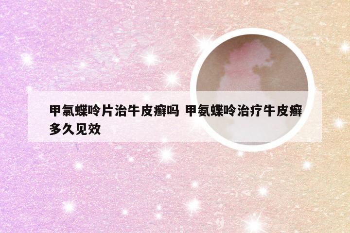 甲氯蝶呤片治牛皮癣吗 甲氨蝶呤治疗牛皮癣多久见效