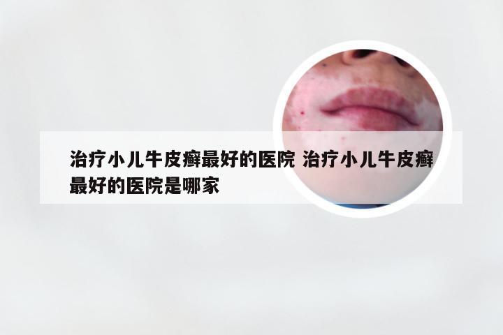 治疗小儿牛皮癣最好的医院 治疗小儿牛皮癣最好的医院是哪家