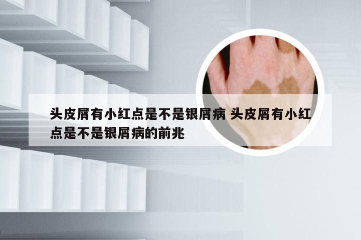头皮屑有小红点是不是银屑病 头皮屑有小红点是不是银屑病的前兆