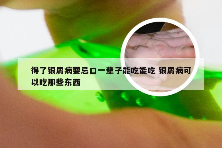 得了银屑病要忌口一辈子能吃能吃 银屑病可以吃那些东西