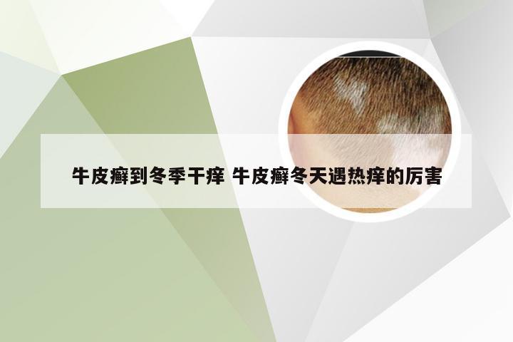牛皮癣到冬季干痒 牛皮癣冬天遇热痒的厉害