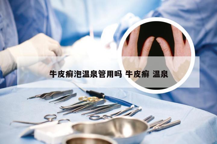 牛皮癣泡温泉管用吗 牛皮癣 温泉