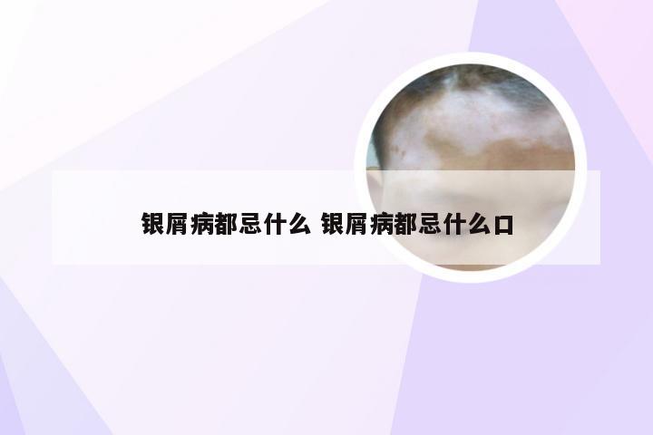 银屑病都忌什么 银屑病都忌什么口