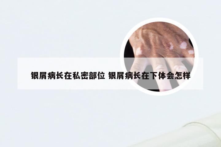银屑病长在私密部位 银屑病长在下体会怎样