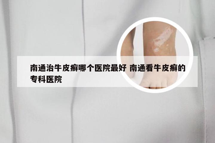 南通治牛皮癣哪个医院最好 南通看牛皮癣的专科医院