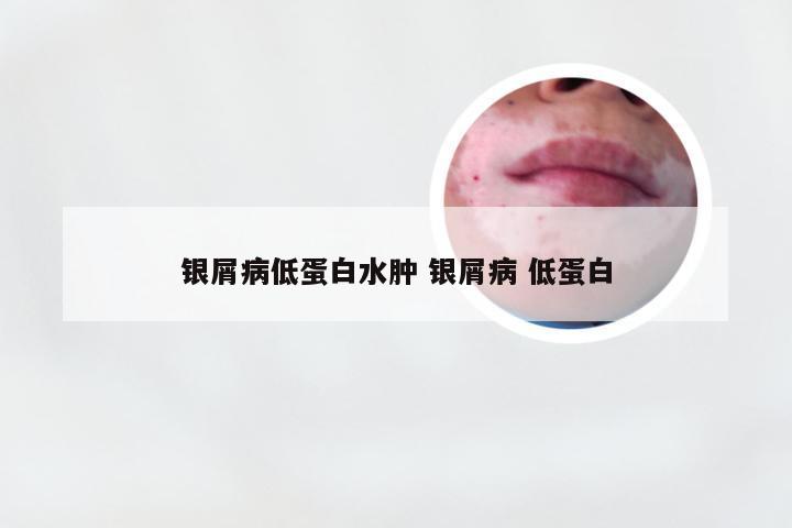 银屑病低蛋白水肿 银屑病 低蛋白