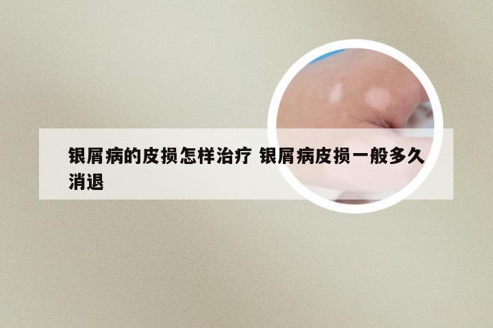 银屑病的皮损怎样治疗 银屑病皮损一般多久消退