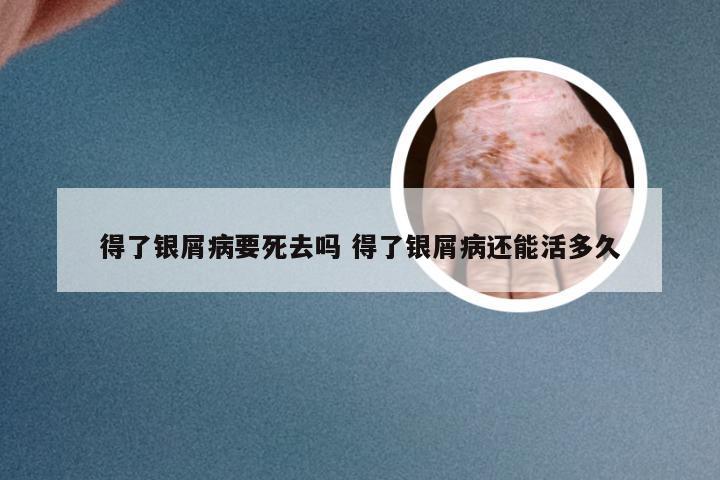 得了银屑病要死去吗 得了银屑病还能活多久