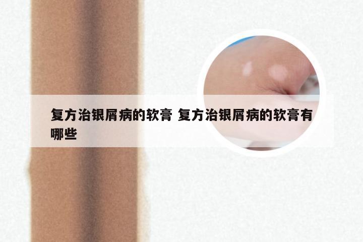 复方治银屑病的软膏 复方治银屑病的软膏有哪些