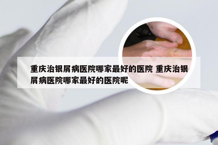 重庆治银屑病医院哪家最好的医院 重庆治银屑病医院哪家最好的医院呢