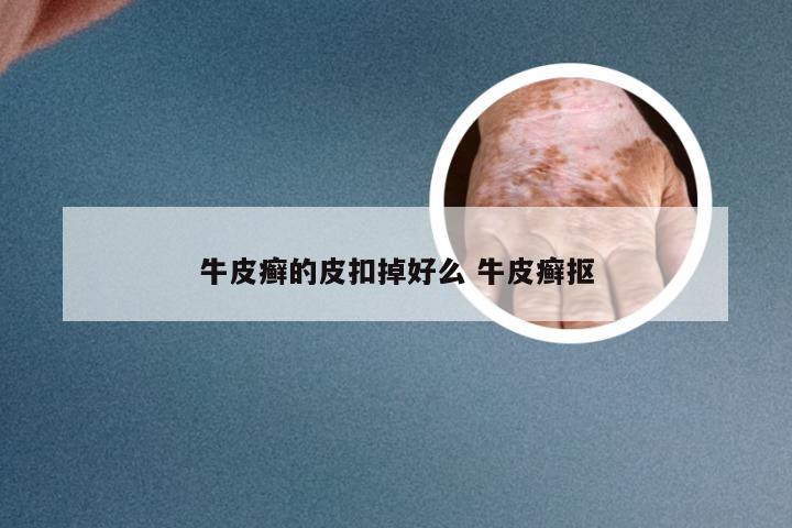 牛皮癣的皮扣掉好么 牛皮癣抠