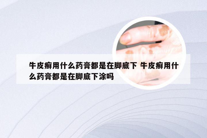 牛皮癣用什么药膏都是在脚底下 牛皮癣用什么药膏都是在脚底下涂吗