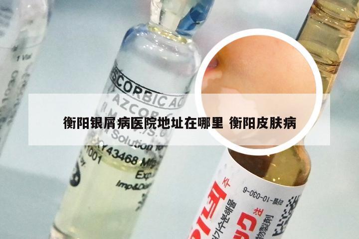 衡阳银屑病医院地址在哪里 衡阳皮肤病