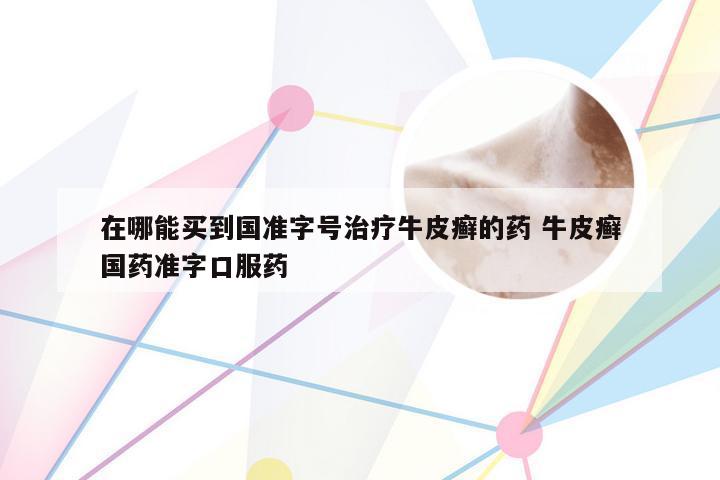在哪能买到国准字号治疗牛皮癣的药 牛皮癣国药准字口服药