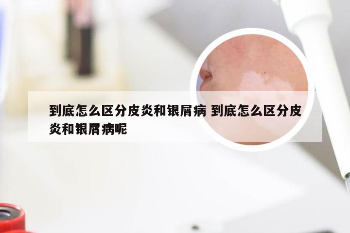到底怎么区分皮炎和银屑病 到底怎么区分皮炎和银屑病呢