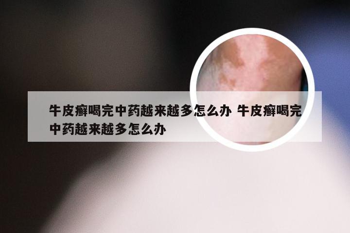 牛皮癣喝完中药越来越多怎么办 牛皮癣喝完中药越来越多怎么办