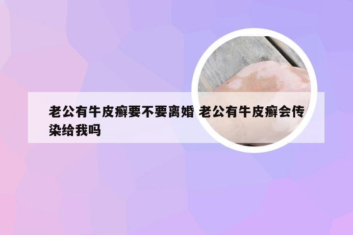 老公有牛皮癣要不要离婚 老公有牛皮癣会传染给我吗