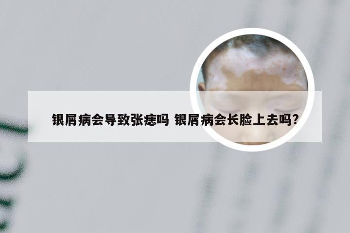 银屑病会导致张痣吗 银屑病会长脸上去吗?