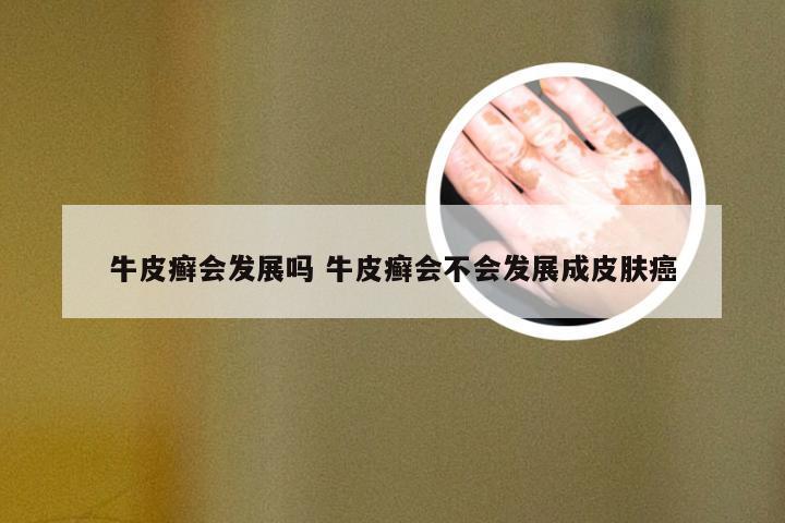 牛皮癣会发展吗 牛皮癣会不会发展成皮肤癌