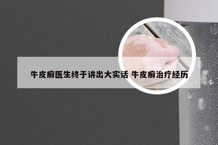 牛皮癣医生终于讲出大实话 牛皮癣治疗经历