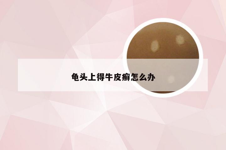 龟头上得牛皮癣怎么办